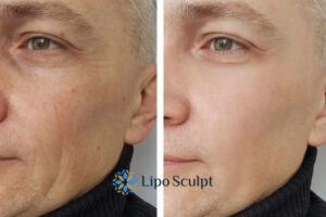 How to Fight Aging Symptoms 3 Fight Aging Symptoms Cheadle With HIFU and Morpheus8 Today!
