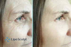 How to Fight Aging Symptoms 2 Do you want to Fight Aging Symptoms Cheadle? Contact Lipo Sculpt today!
