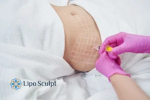 Are The Results From Aqualyx Permanent? 1 Do you want to know how long Aqualyx Cheadle results last?