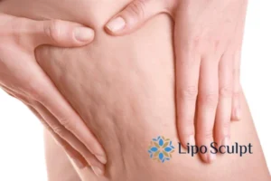 CoolSculpting for Legs: The Innovative Approach to Redefining Your Legs 5 Start your journey today book your coolsculpting treatment Cheadle online today!