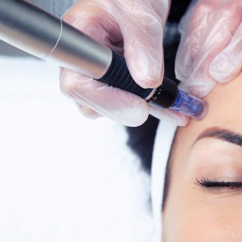 Morpheus8 treatment Cheadle from Lipo Sculpt - Book in today!